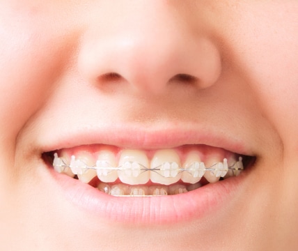 A close-up of a smiling person with braces on their teeth, showing metal brackets and wires. No landmarks or historical buildings visible.