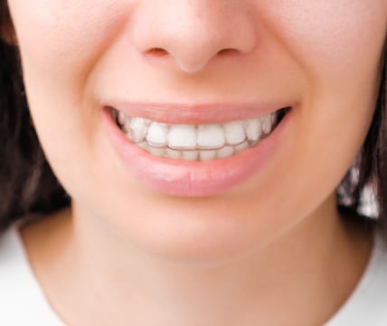 A close-up of a person's mouth showing teeth with orthodontic aligners. The person appears to be smiling slightly. No landmarks or buildings are visible.