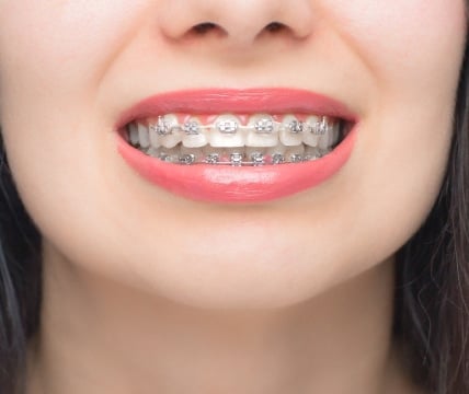 A close-up of a person smiling, revealing teeth with braces and wearing bright pink lipstick. No landmarks or historical buildings are visible.