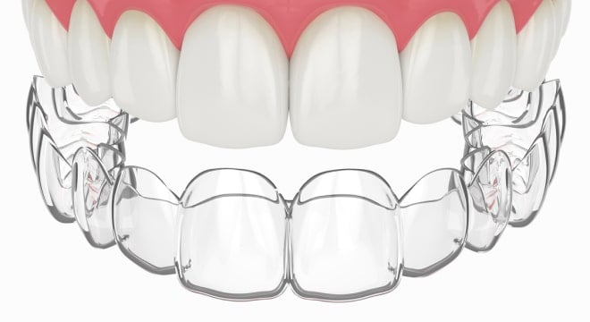 Clear removable retainer