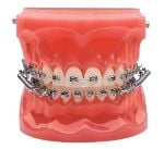 Dental model showing teeth with metal braces and springs, demonstrating orthodontic alignment. The gums appear pink, providing a realistic anatomical display.