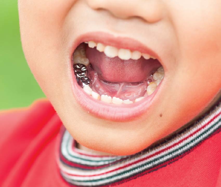 Close-up of a child’s open mouth, showing several decayed teeth and fillings. The child is wearing a red shirt with striped collar.