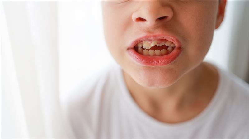 thumb sucking teeth effects